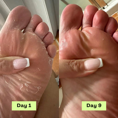 Tea Tree Athlete's Foot Defense Soap