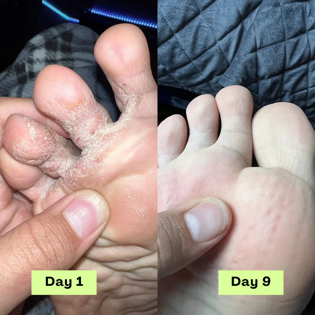 Tea Tree Athlete's Foot Defense Soap